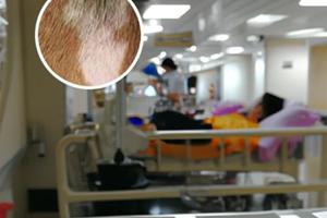 黑色素減少是什么癥狀引起的